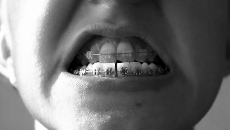 Aparat dentar safir