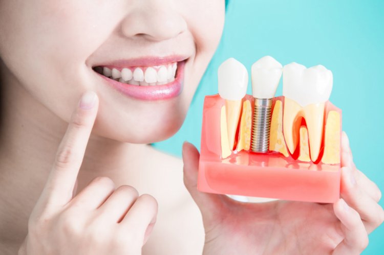 Unde poti beneficia de implant dentar in sectorul 4 de calitate premium?