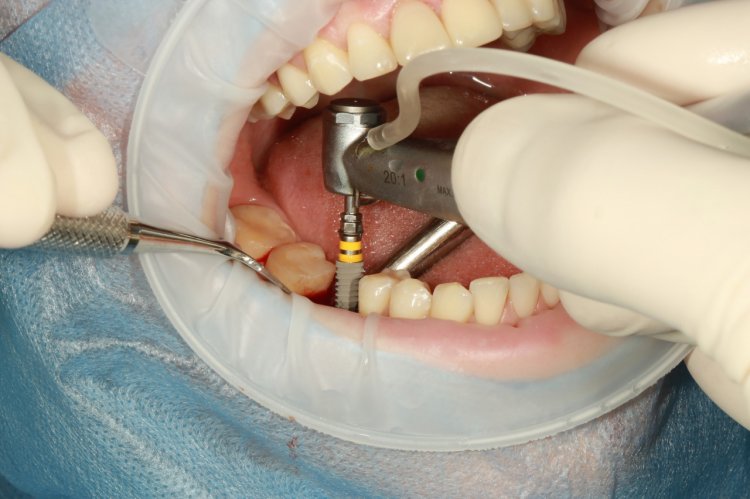 4 mituri despre implantul dentar