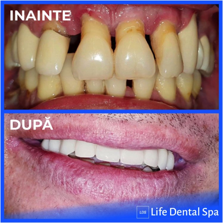 Dinti ficsi pe implanturi in doar 8 ore - Life Dental Spa
