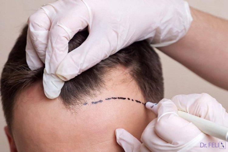 Transplant de păr între doi pacienți compatibili, doar în cadrul clinicii Dr. Felix Hair Implant!