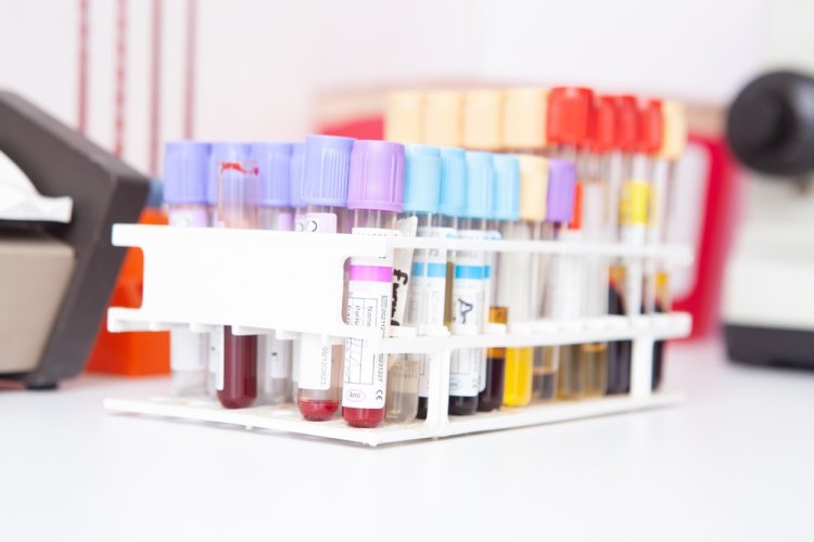 VSH (viteza de sedimentare a hematiilor): ce trebuie să știi despre acest test