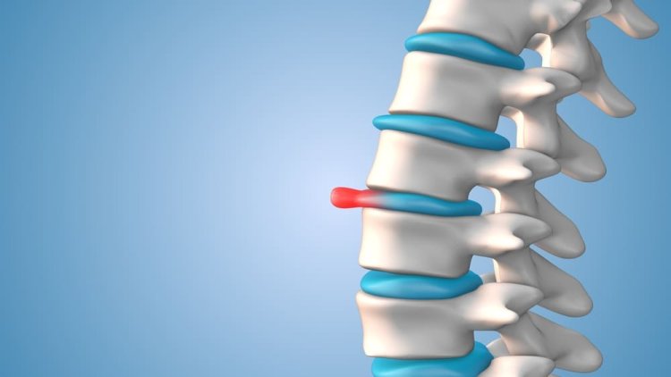 Cum să tratezi și să previi hernia de disc
