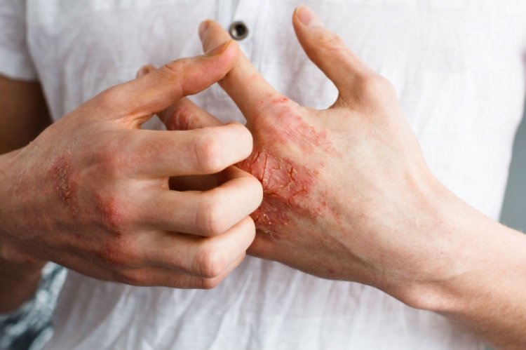 Simptome comune alte dermatitei atopice și metode de ameliorare