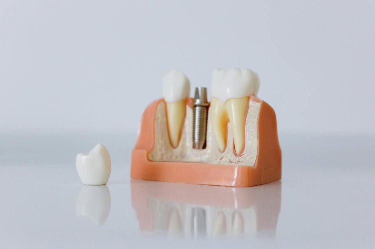 Implant dentar în București – soluția modernă și durabilă pentru un zâmbet sănătos