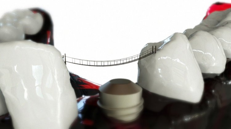 Implant dentar în sector 6 – soluția durabilă pentru un zâmbet desăvârșit